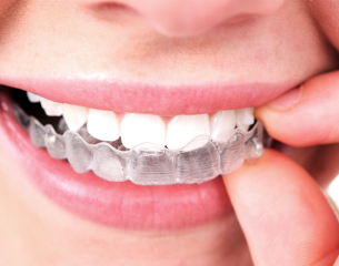 Invisalign Teeth Straightening